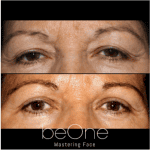Blefaroplastia para devolver juventud a la mirada - Clínica maxilofacial beone face mastering en madrid