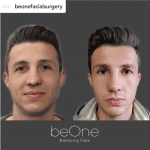 RINOPLASTIA SECUNDARIA PARA CORREGIR UNA INTERVENCIÓN ANTERIOR - beOne face mastering Madrid