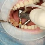 beneficios estéticos y funcionales de los implantes dentales
