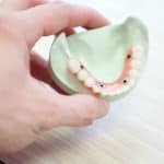 Cuántos implantes se necesitan para una dentadura completa