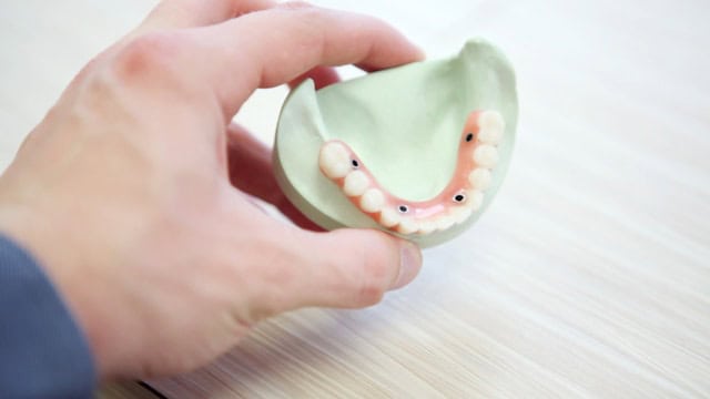 Cuántos implantes se necesitan para una dentadura completa