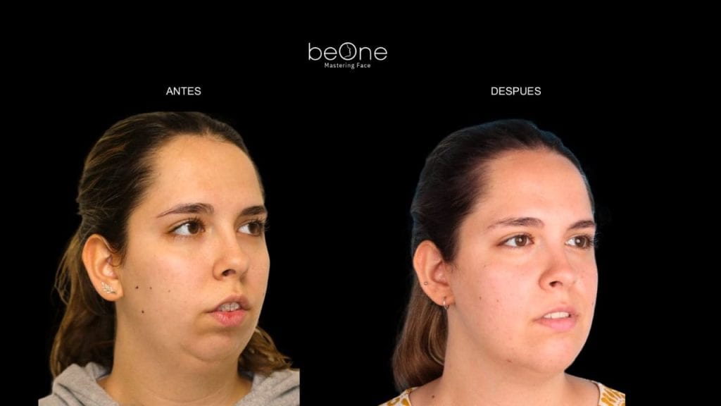 Cirugia Ortognatica antes y después