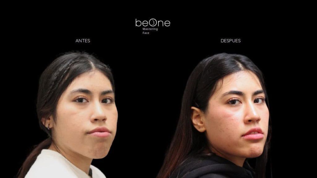 Cirugia Ortognatica antes y después