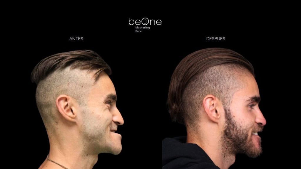 Cirugia Ortognatica antes y después