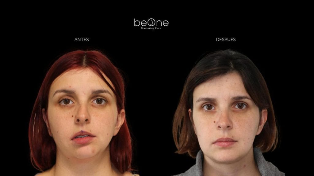 Cirugia Ortognatica antes y después