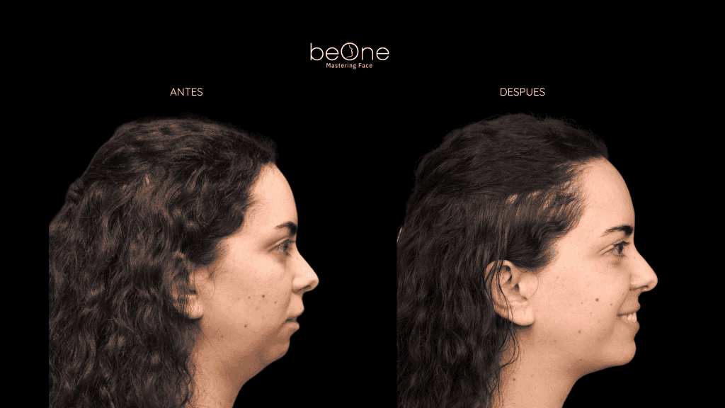 Cirugia Ortognatica antes y después