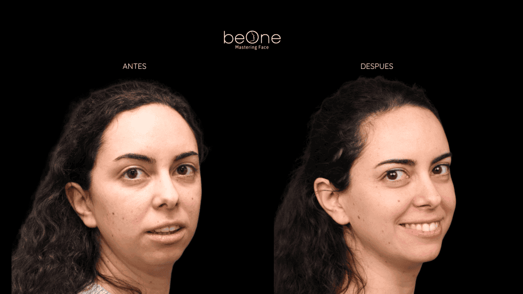 Cirugia Ortognatica antes y después