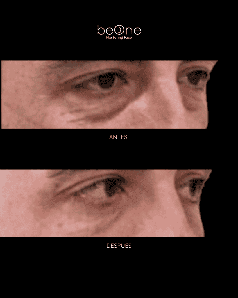 Blefaroplastia antes y después
