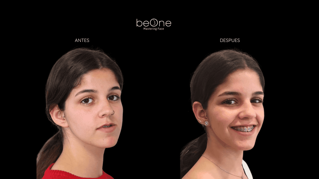 Cirugia Ortognatica antes y después