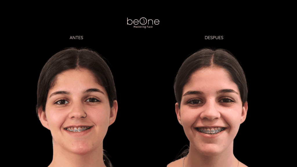 Cirugia Ortognatica antes y después