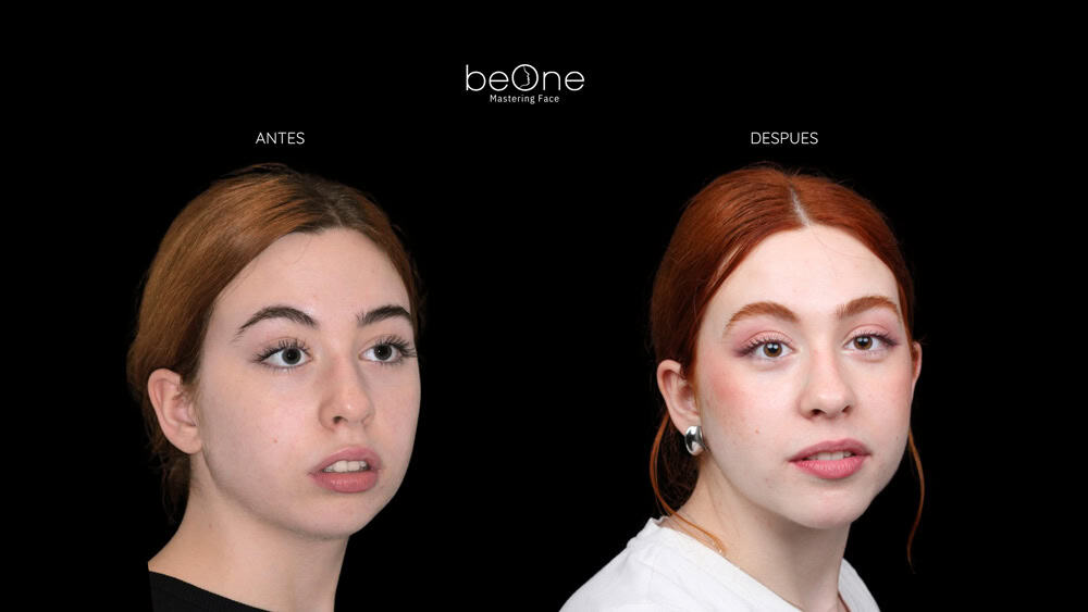 Cirugia Ortognatica antes y después