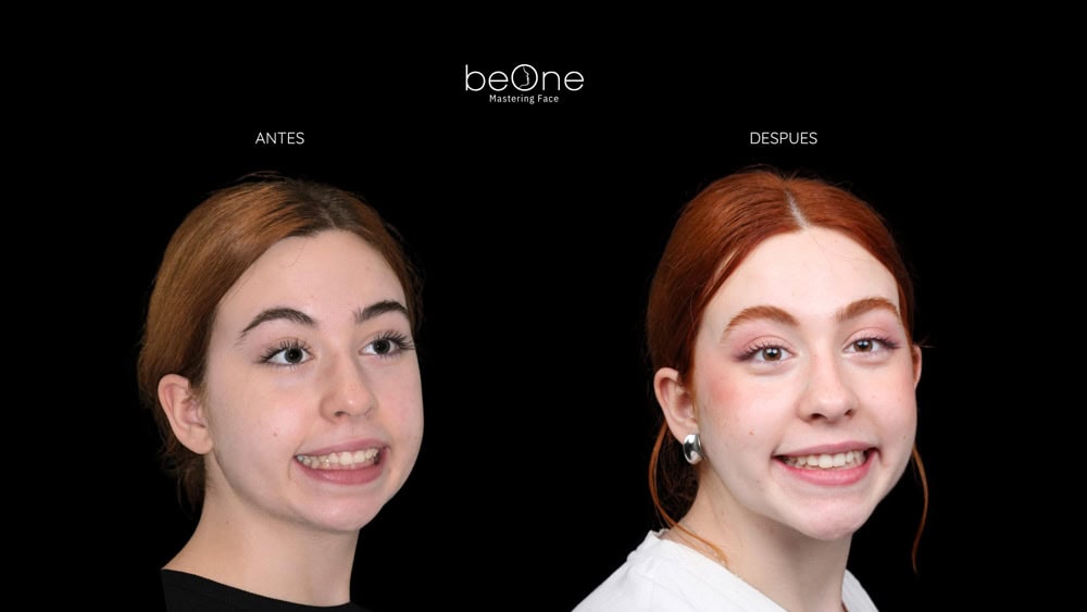 Cirugia Ortognatica antes y después