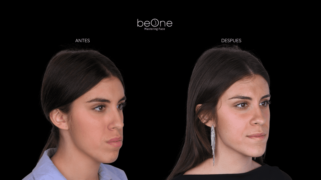 Cirugia Ortognatica antes y después