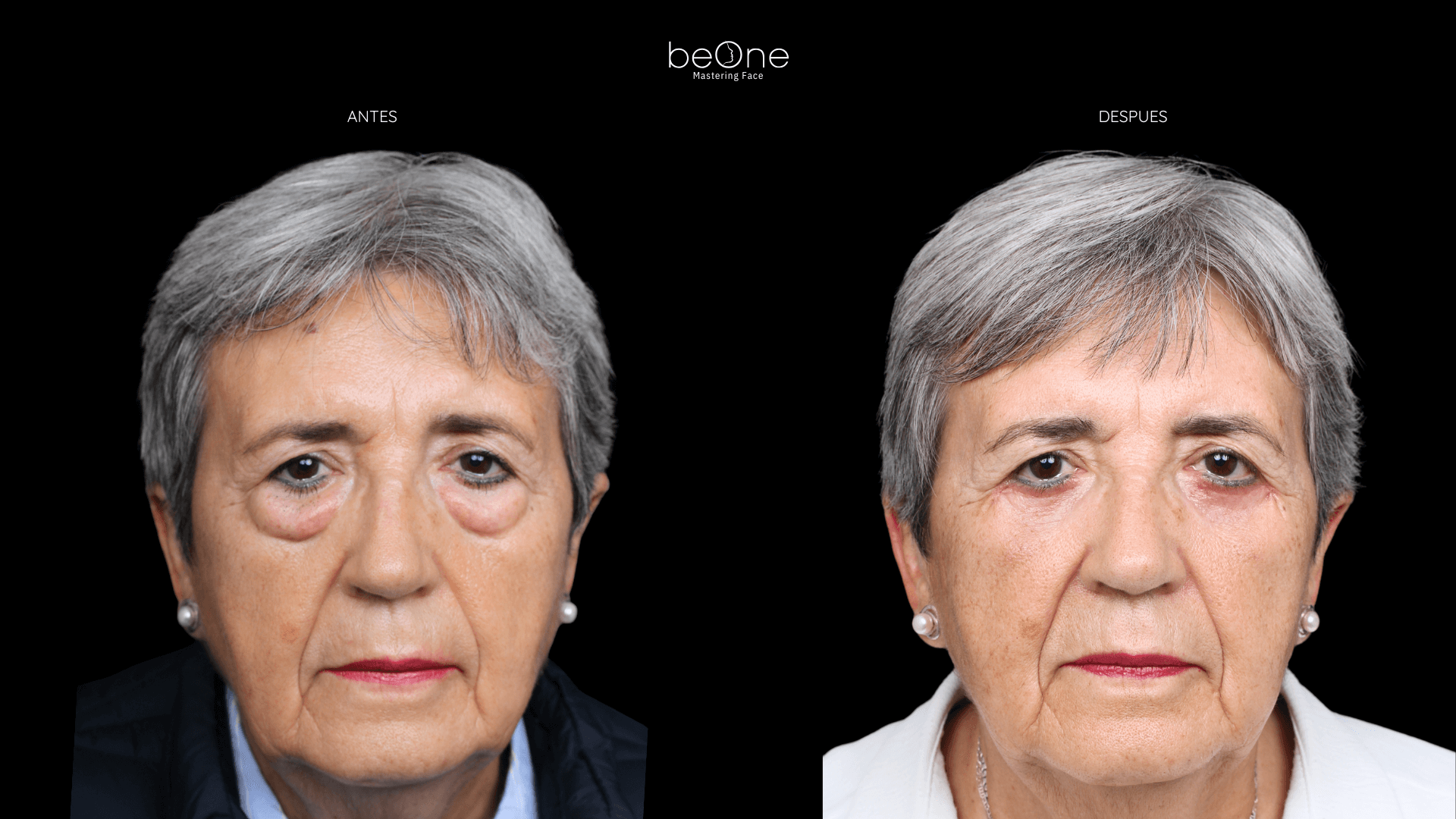 Blefaroplastia antes y después