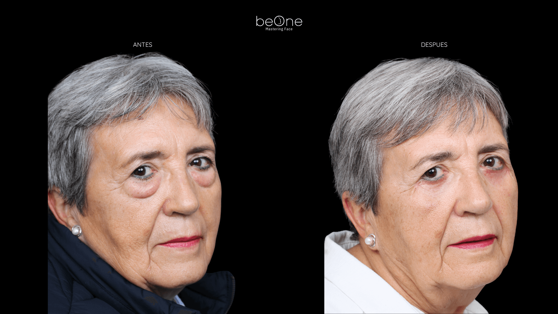 Blefaroplastia antes y después