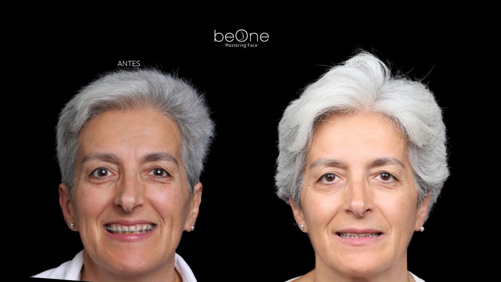 Cirugia Ortognatica antes y después