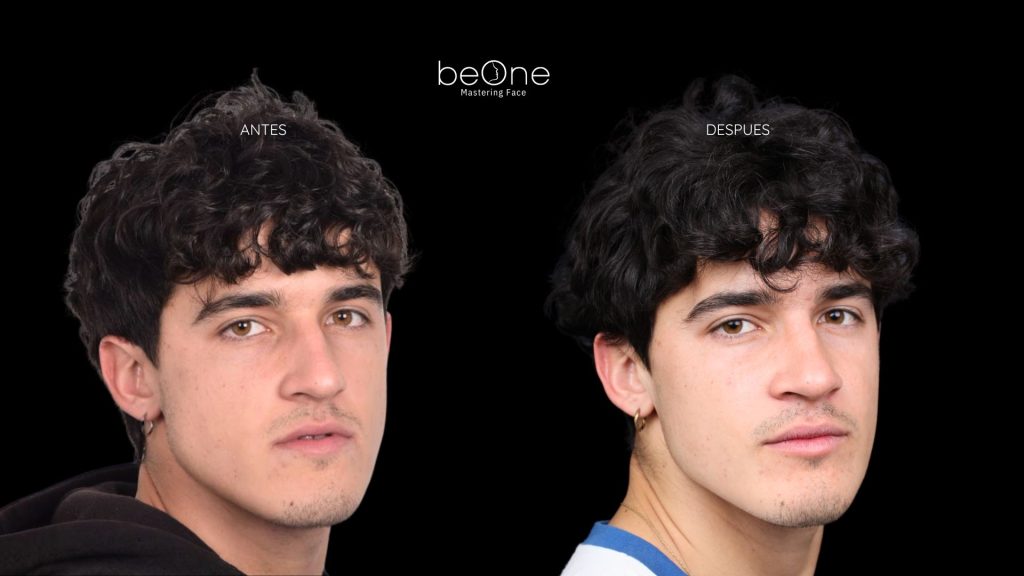 Cirugia Ortognatica antes y después