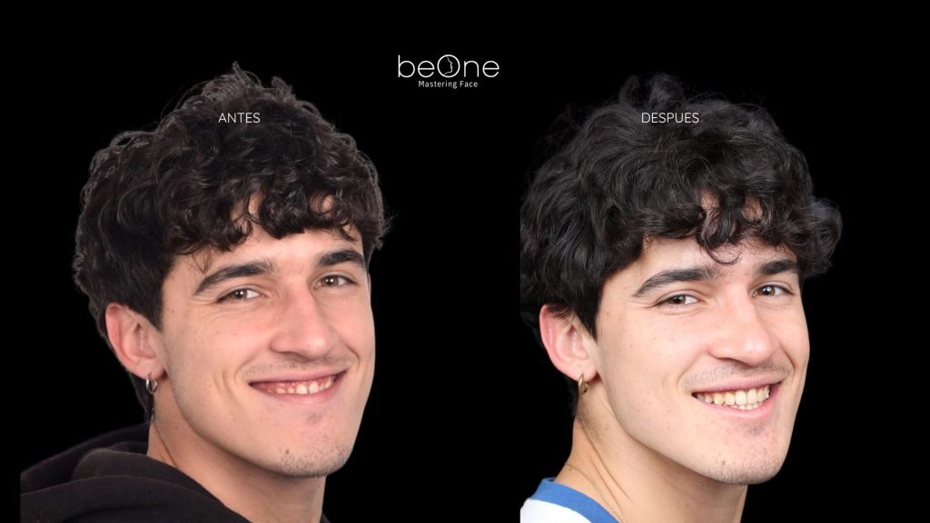 Cirugia Ortognatica antes y después