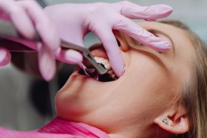 alveolitis dental